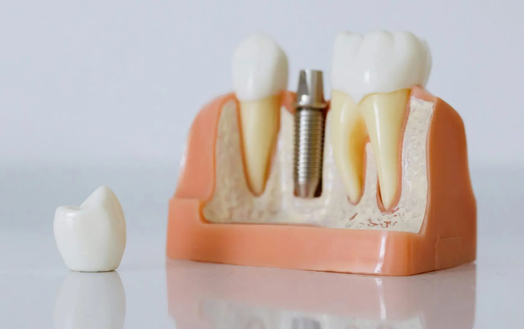 Implantes de carga inmediata en Córdoba