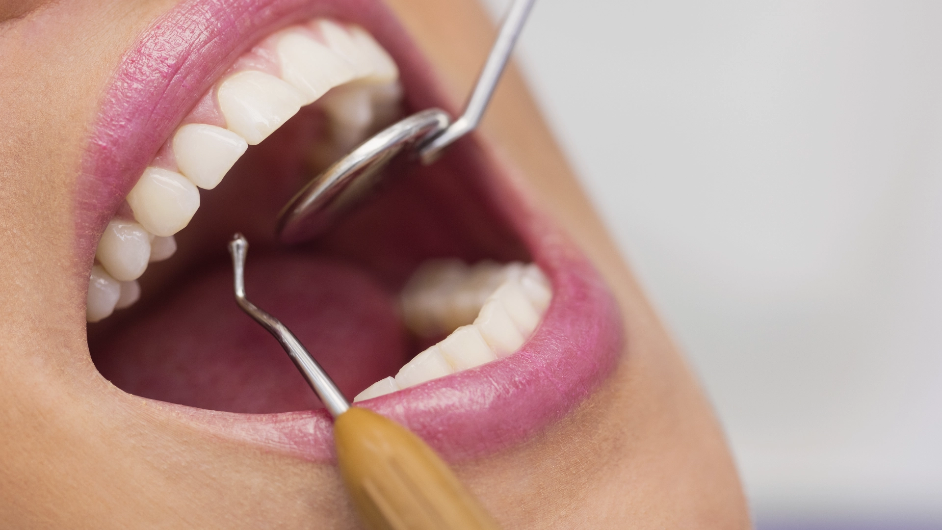 Composite en estética dental
