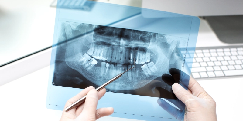Retraimiento endodontico